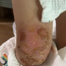 효제한의원 | 경주시 아토피피부염 치료 잘하는 곳 아토5분