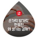 손가락 발가락 한포진 왜 생기는걸까? 이미지