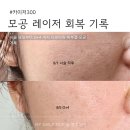 1회 사진기록전 | 포텐자 알아보다 선택한 카이저300 1회차 후기 l 모공 시술 경과 기록