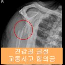 교통사고 합의금 많이 받는 방법 [견갑골 골절 교통사고 합의금] 이미지