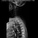 whole spine x-ray 이미지