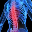 Spinal cord injury treatment : Scenar 이미지