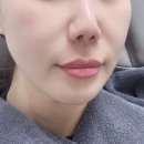 명동피부과 쥬베룩볼륨 팔자주름 10일차 후기