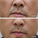 비에이의원 | 천안팔자주름 필러 내돈내산 대만족 후기 얻으려면