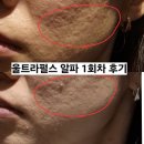 차그리고공감 | 울트라펄스 알파 여드름패인흉터 1회차 후기, 다운타임 2주 경과 총정리