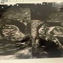 청구2차 | 임신 중기 2차 정밀초음파 후기 | 검사 항목, 비용 , 단체보험 청구까지