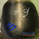 (주)우리생약 | 여자 가르마 탈모 정수리 탈모 생기는 이유 + 원인별 해결법(후기)