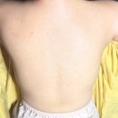 다나음 바디케어 | [일산/백석] <솔에스테틱 일산점> 등드름 싹다 없애자! 바디트러블케어 등관리 후기