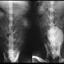 경정맥 요로 조영검사[intravenous urography] 이미지