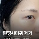 고려한의원 | 화** 한의원 강서목동점 피부과 한의원 거우침으로 편평사마귀 제거한 내돈내산 후기