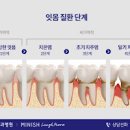 잇몸질환 치주질환 증상 원인 예방법 이미지