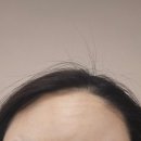 닥터에버스의원 | 광주상무 닥터에버스의원 예신관리 보톡스 및 LDM 관리 후기(관리 직후 및 일주일 뒤)