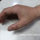 남성반점 이미지