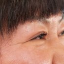 내돈내산 강남성형외과 눈밑지방재배치 하안검 1개월차 후기