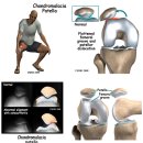 슬개골 연골 연화증 이란? 이미지