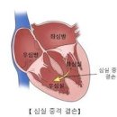 카페심실 이미지