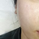세가지 뷰티 | #용인피부관리 전문샵 세가지뷰티 MTS 시술 후기