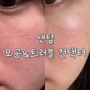 부산 센텀피부한의원 여드름흉터 치료 모공&amp;트러블 컨택터 후기
