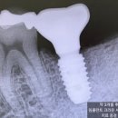해보철물 | 치료 어떻게 하나요?" 뿌리만 남은 어금니 튼튼하게 무절개 임플란트 해 드린 후기 [공덕동 임플란트]