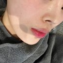 능성한의원 | 신사역 피부과 미라젯 리쥬란 유니크부스터 2cc 시술 효과 무통 통증 엠보