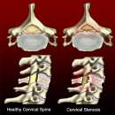 척추관 협착증 (spinal stenosis) 이미지