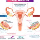 다낭성 난소 증후군 다낭성 난소 증후군 원인 다낭성 난소 증후군 다낭성난소증후군 뜻 임신 진단 이미지