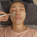 예스필의원 | 압구정 예스필 필링 피부시술 솔직후기