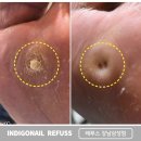 건강 셀프 발 마사지 | 가로수길 발굳은살 티눈 뿌리 제거 후기