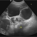 Autosomal dominant polycystic kidney diseaseu 상염색체 우성 다낭성 신장질환 이미지