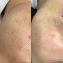 빙그루밍 | [피부과 후기] 생애 첫 피부과 관리 후기,흉터관리 피부관리 솔직후기