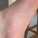 상상메디약국 | 메디좀 스프레이 발바닥 각질 무좀 사용 후기