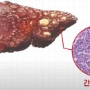 B형 간염과 C형 간염의 최근 치료법과 항바이러스제 복용이 간암 예방에 미치는 효과 이미지