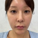 눈의꽃성형외과의원 | 서울아몬드성형외과논현점 절개 쌍꺼풀수술 눈위꺼짐 눈두덩이지방이식 가격 붓기 후기 5일차