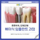교대역인앤인오피스 | 뼈이식 임플란트 과정, 재수술 위험 낮추는 치과 선택 방법은?