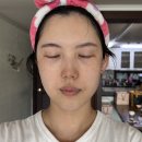 만성인셀덤 | 인셀덤 3개월 진솔한 사용후기 피부톤 / 만성여드름 / 얼굴형변화