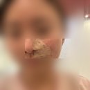 미테크성형외과의원 | 부산 진피내모반(튀어나온 점) 제거 수술 후기