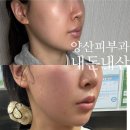 피부관리(얼굴) | 양산 피부관리 리프팅 후기 얼굴 변화 리얼 공개