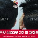 모먼트의원 비절개 히든컷 모발이식 4400모 2주차 후두부 채취부위 뒷모습 (남자 / 김경복원장) 이미지