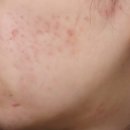 로담한의원 | 로담한의원 새살침 코라테라피 후기, 패인 여드름흉터 모공 케이스