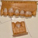 좋은솜씨죽전치과의원 | 죽전 치과 치경부 마모증 레진 대신에 세라믹을 쓸 수 있을까?