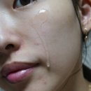 심플루틴 | 콧등여드름 고민, 알란토인 성분으로 루틴 바꾼 후기