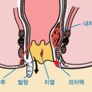 치질 자가 관리하는 방법 이미지