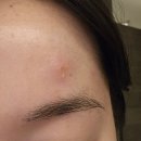 국홍일국정표피부과의원 | [병원] 얼굴 대상포진 치료과정 (feat.국홍일국정표 피부과의원)