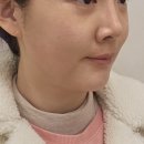 프라임 | 신사역피부과 40대초반 프라임레이즈 후기 (효과,통증,부작용)