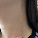 금정라인한의원 | 금정 라인한의원, 편평사마귀 제거 as 후기