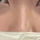 삼주약국 | 피부과]눈밑지방재배치, 눈밑지방이식 찐 리얼 내돈내산 후기(2)_한달 후, 2달 후, 2차 지방이식(사진O)