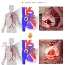 심방중격 결손증[atrial septal defect , 心房中隔缺損症] 이미지