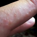 손가락에 ‘이것’ 있다면 밀가루와 우유 줄여야 한다는 신호 이미지