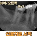 찬치과기공소 | 치아 교모증 치료 방법을 마천동 치과 에서 알려드려요