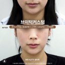 뷰티바성형외과의원 | AI피부진단기 후 브이턱커스텀 얼굴리프팅 (뷰티바성형외과)